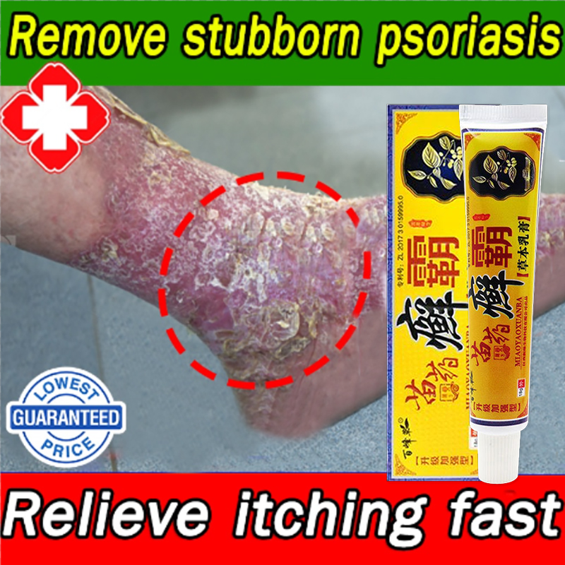 Sumifun Eczema Treatment Cream Atoderma Cream Original Gamot sa kati