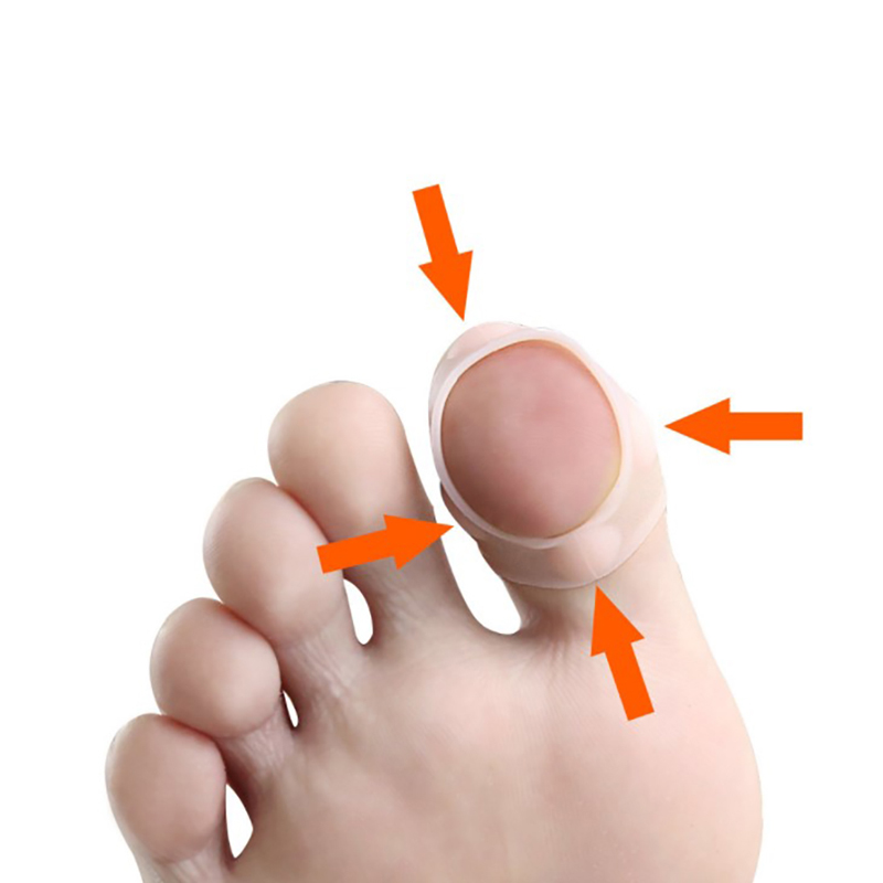 The Big Ups????1Pair Silicone Ingrown Toenail Correction Tool Invisible