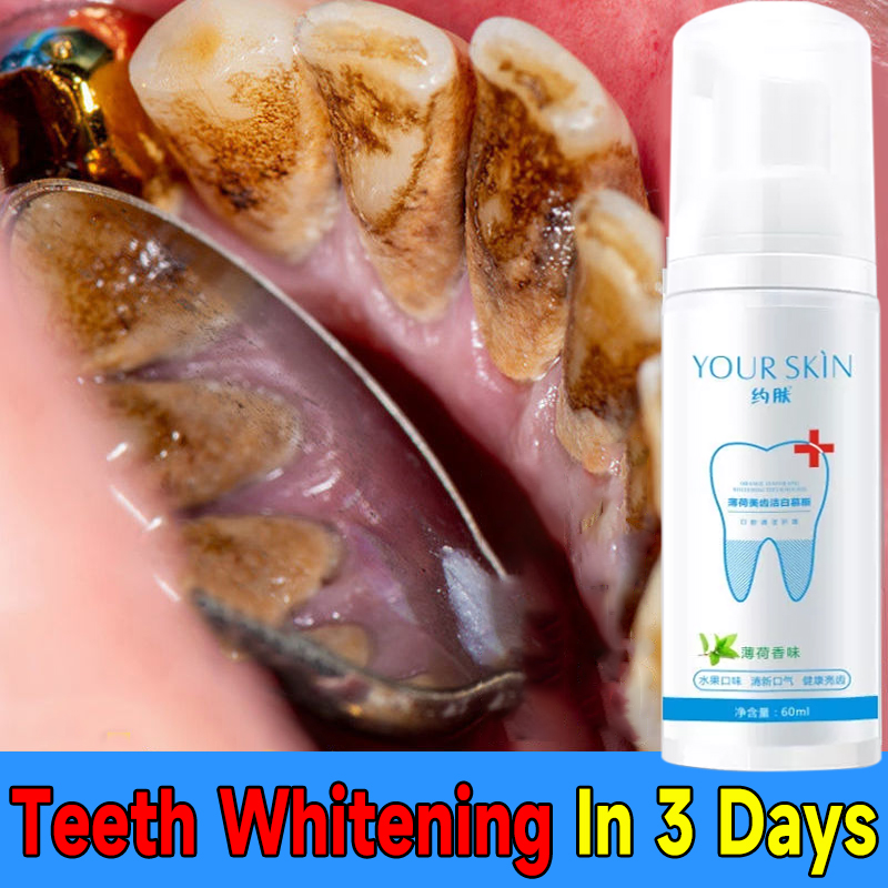 【Local delivery】 ALIVER Cleaning Teeth Whitening Mousse Foam Toothpaste