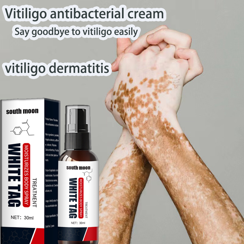 Photo inspiration: Eliminated Vitiligo Reference: Spot South Moon Vitiligo Treatment Cream Vitiligo Net Spray Sweat