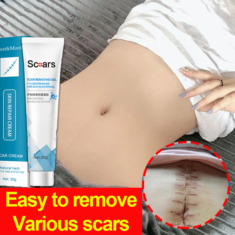 Doctor Scar Removal Gel Acne Mark Removal Gel Ointment Scar