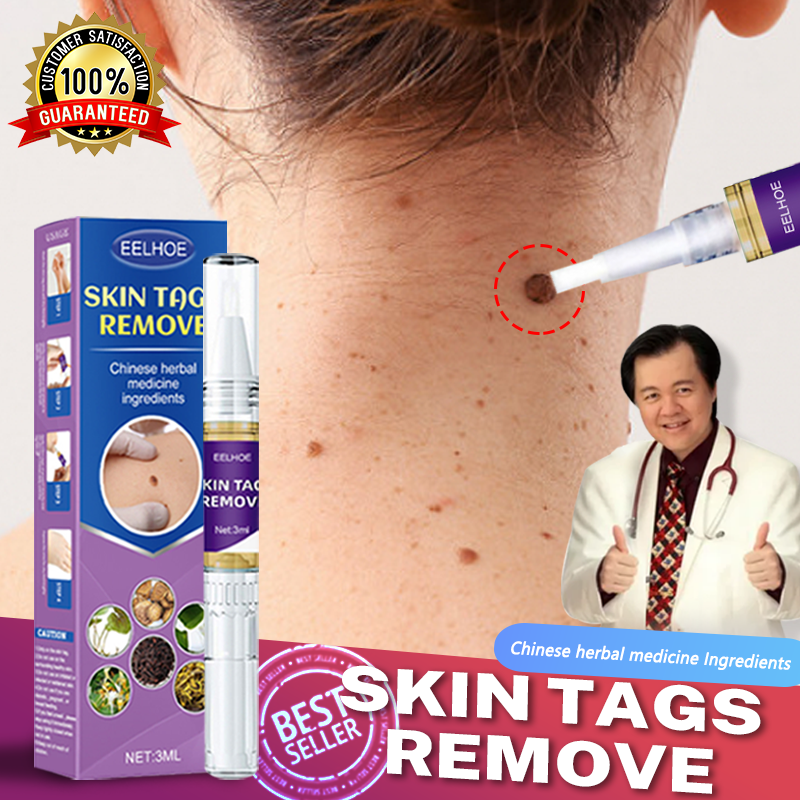 warts remover original watson warts removal mole and warts remover skin ...