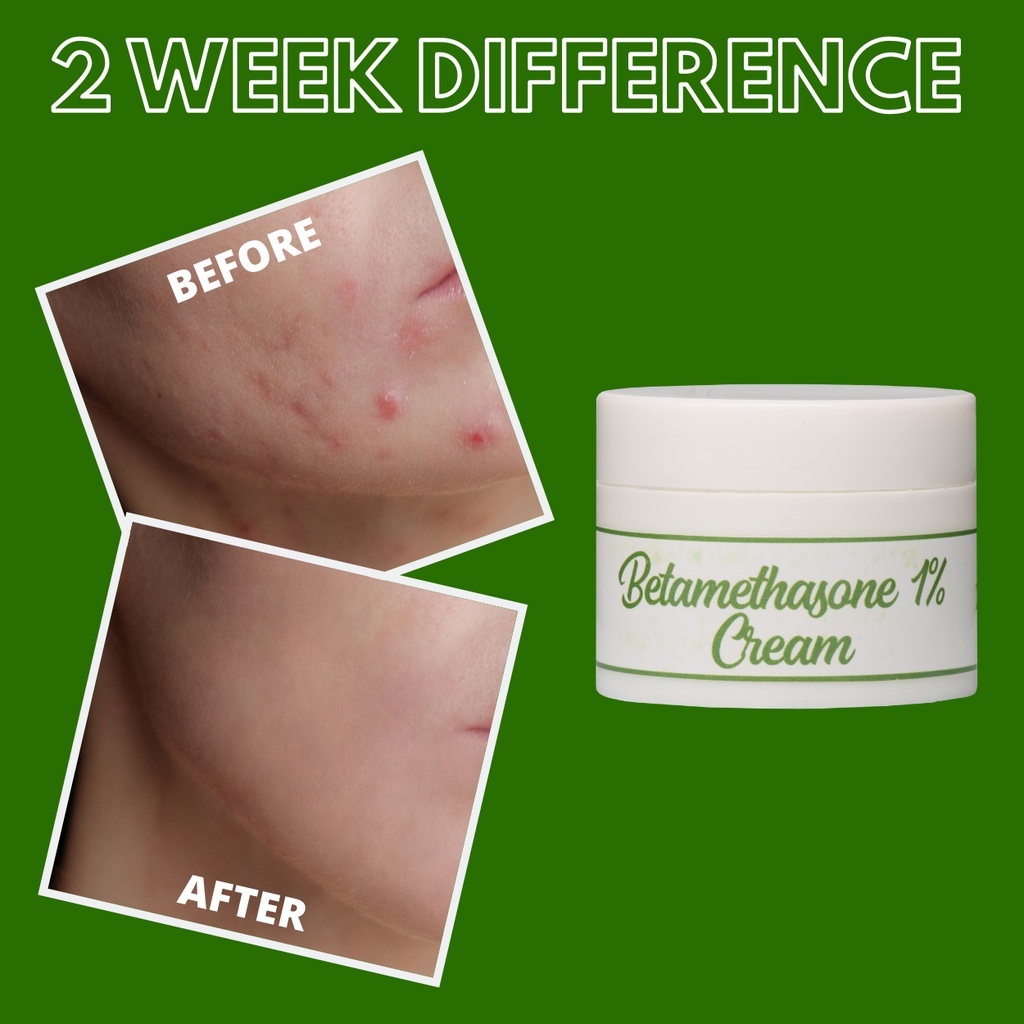 [ BETAMETHASONE CREAM ] Greenika Betamethasone Steroidal Cream Treats