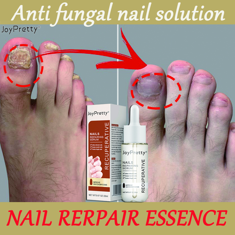 JoyPretty Treatment Of Onychomycosis Immediate Results Effectively Treat  Fungal Nail Infections Powerful Nail Repair Liquid Brighten And Whiten  Nails Restore Healthy Nail Growth Removal Of Fingernails And Toenails  Ringworm Give You Beautiful
