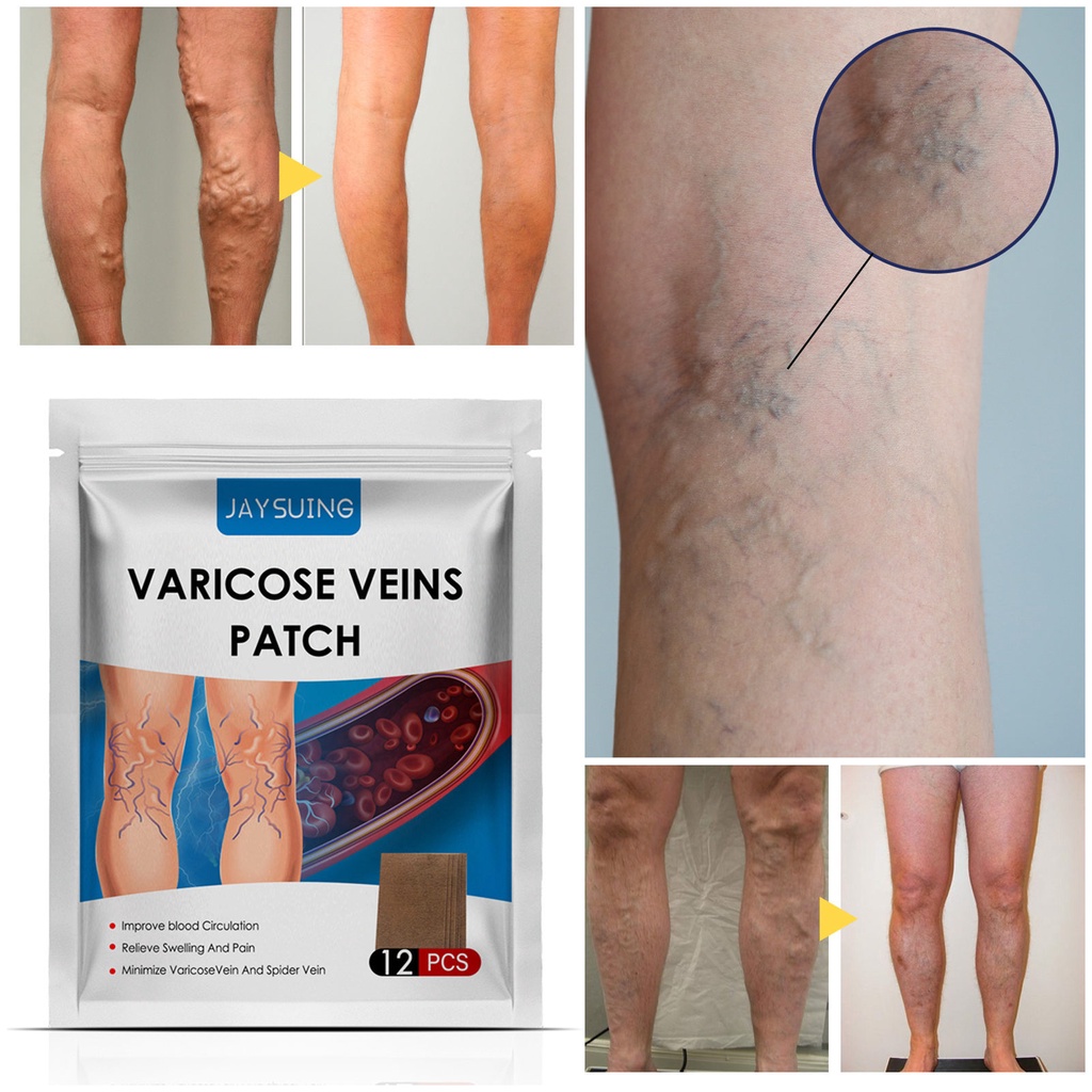 12PCS Varicose Veins Plaster Natural Varicouse Veins Patch Original ...