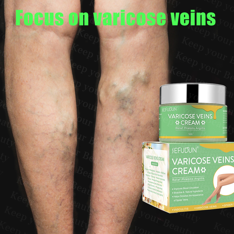 【Effective In 3 Days】SEFUDUN Varicose Vein Treatment Cream Spider Vein ...