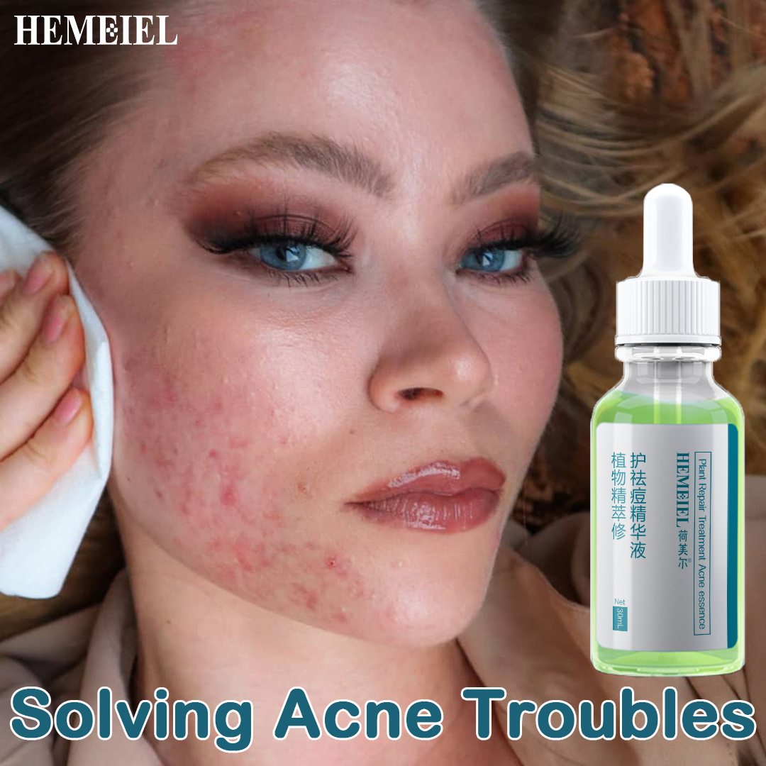 hemeiel-effective-acne-serum-remove-acne-scars-serum-acne-repair-serum