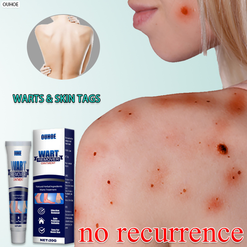OUHOE Wart removal cream Wart Remover Ointment Warts Remover Genital