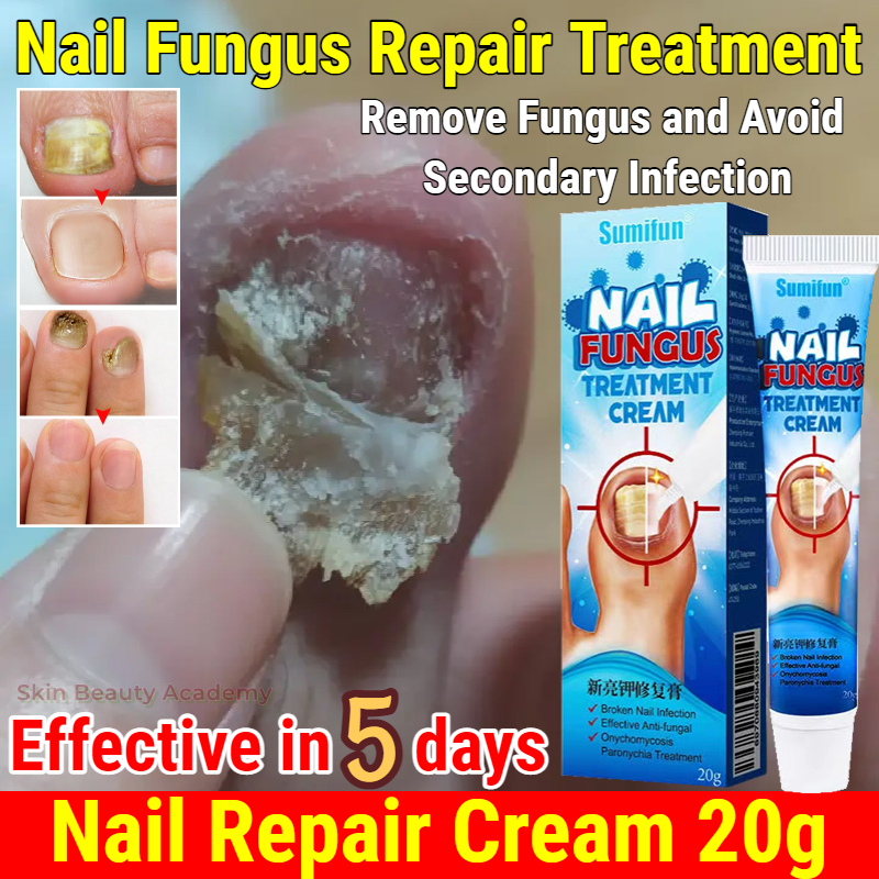 Buy Earthen Echo Nail Fungus Oil, Anti-Fungal, Natural Effective Nail Fungus  Relief Oil, Herbal Essential Oil, Fast-Acting Infections & Nail Fungus Oil  - 50ml Online at Best Prices in India - JioMart.