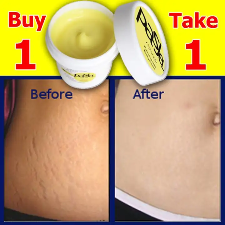 affordable stretch mark removal