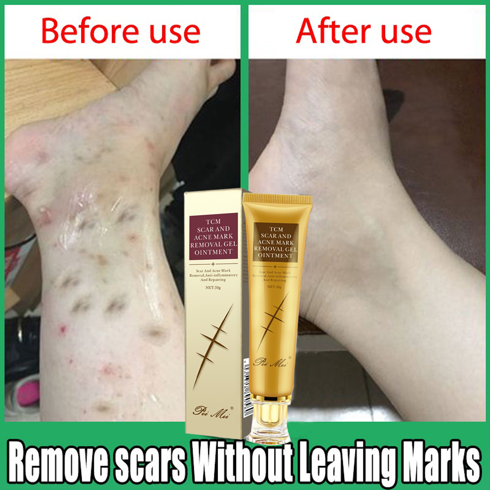 Fix Scar Removal Original Scar Acne Scars Remover For Old Scars Face Repair Cream For Old Scar 7239