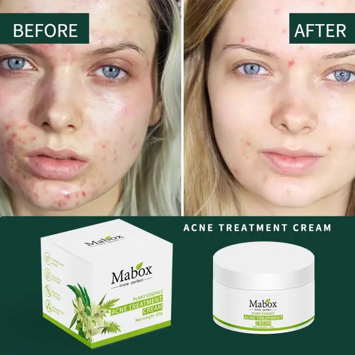 medicated face cream for acne