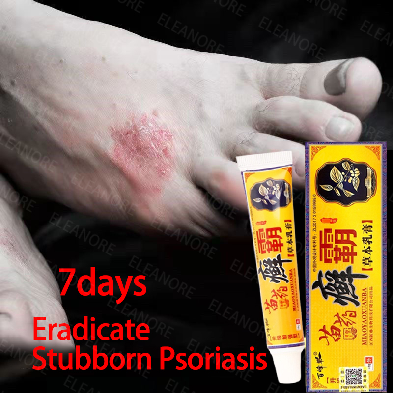 Psoriasis Cream 20g 100 Effective Psoriasis Ointment Psoriasis Cream