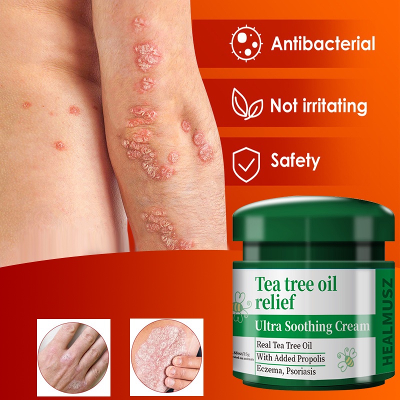 Sell like hot cakes itching cream dermatitis eczema cream itchy skin