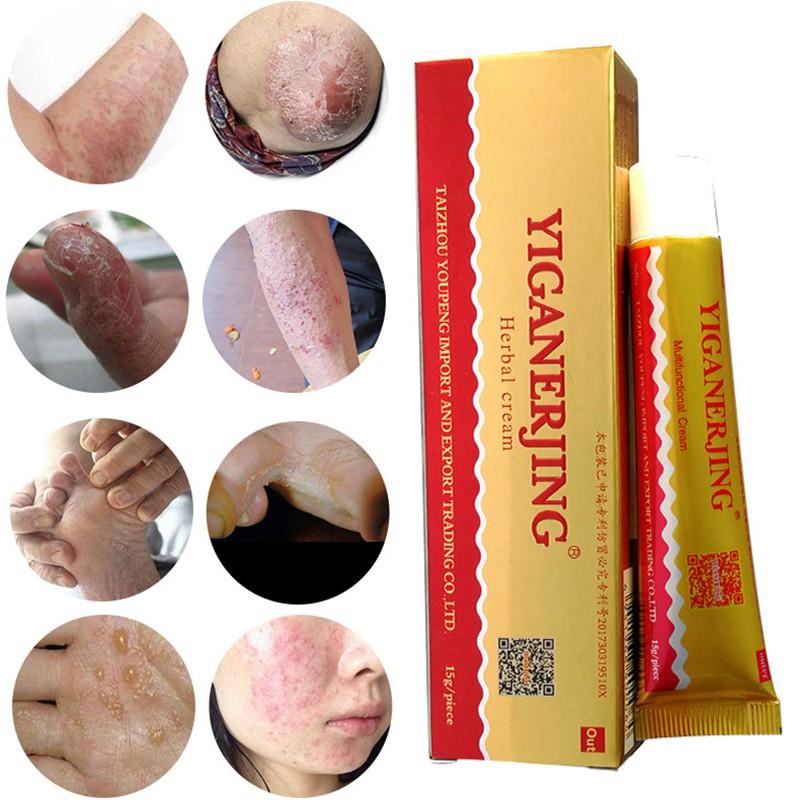 Yiganerjing Natural Chinese Herbal Medicine Cream Eczema Dermatitis ...