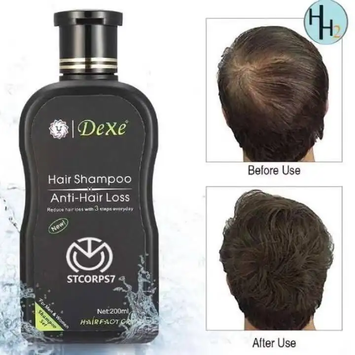 Mzdaily 2 In 1 Dexe Anti Hair Loss Shampoo With Advance