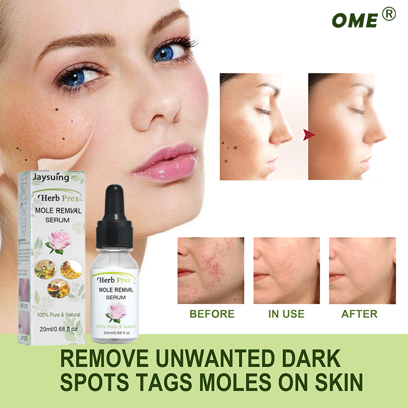 Jaysuing Dark spots, freckle, dark spots, no marks Mole Removal Cream ...