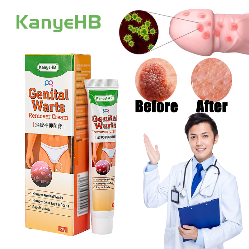 Kanyehb Warts Remover Ointment Genital Herpes Genital Condyloma Acuminatum Fast Effective 2340