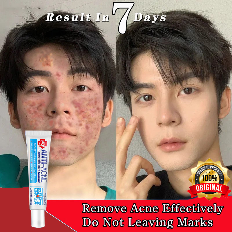 100-effective-remove-pimples-anti-acne-cream-acne-treatment-gel-scars