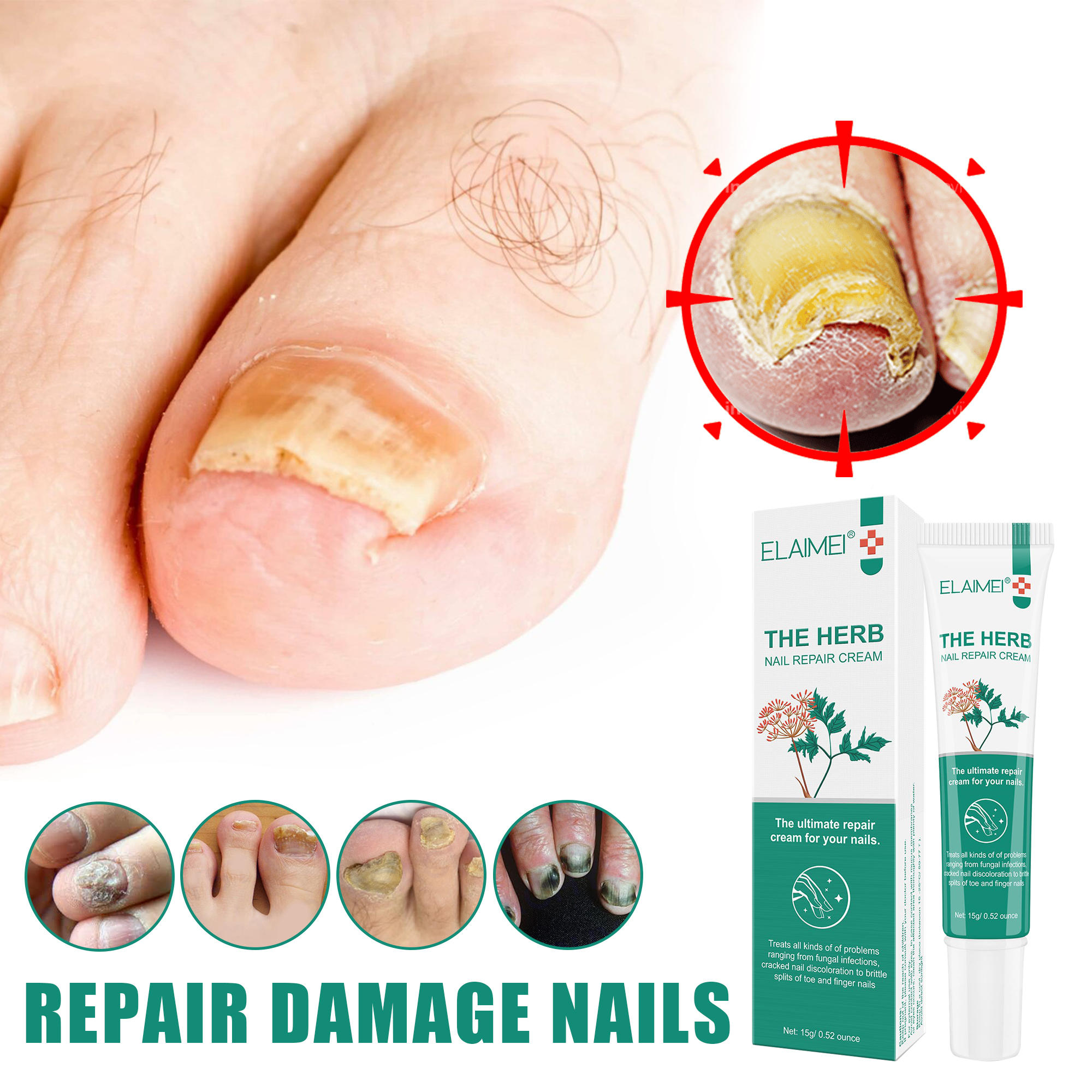 Quality] Nail Repair Liquid Treatment Of Onychomycosis, Paronychia, Anti-  Fungal, Nail Repair Essence, Nail Cream, Nail