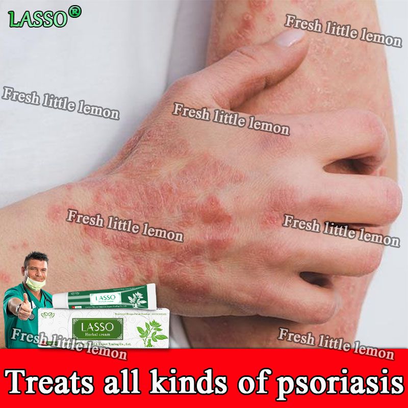 【Treats all kinds of psoriasis】LASSO Psoriasis Cream atoderma cream