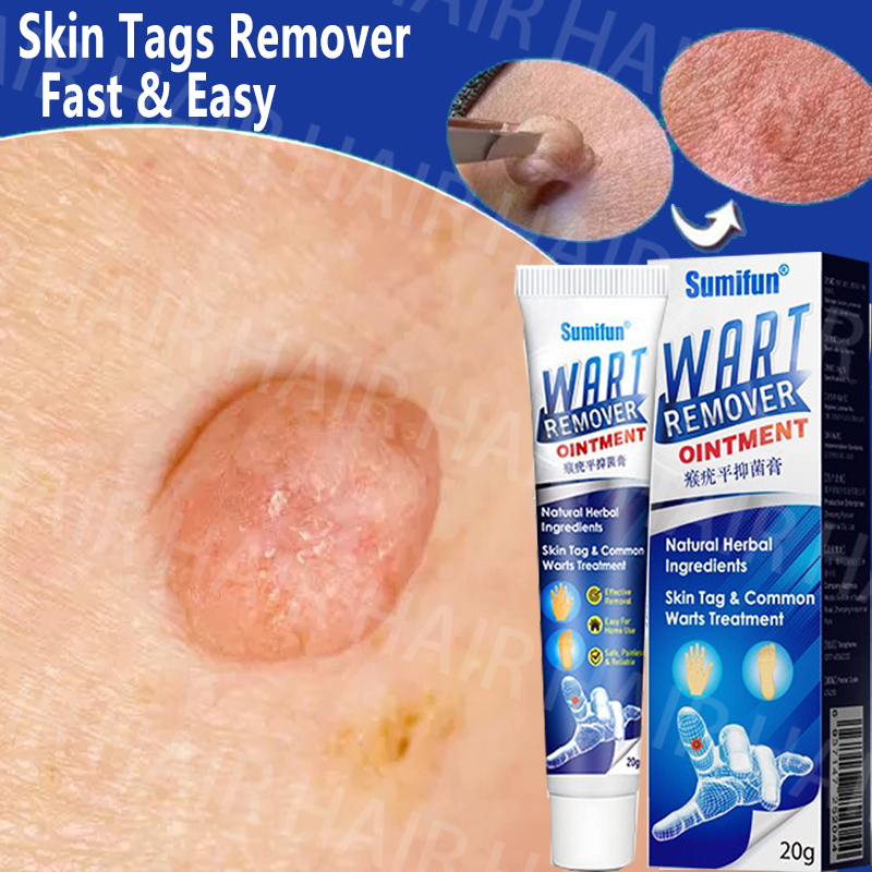 【sumifun】warts Remover Original Cream Warts Magic Remover Wartz Removal Cream 20g Warts Remover