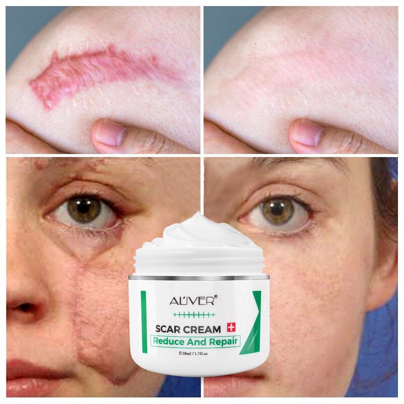 Aliver Surgical Scar Cream Peklat Repair Skin Care Stretch Marks Burn