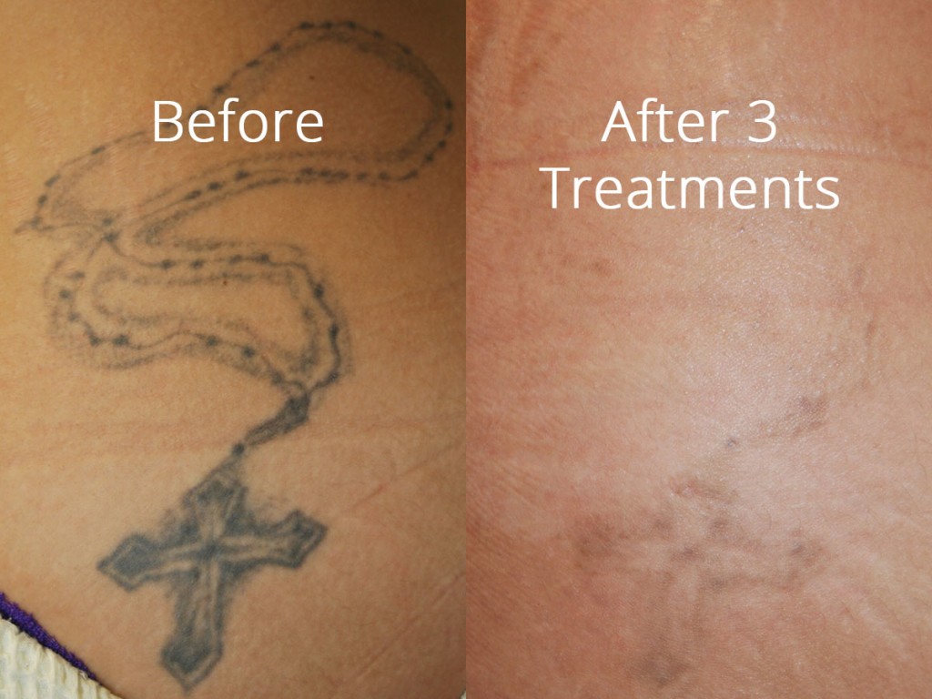 Laser Tattoo Removal | ReviVe PH | Lazada PH