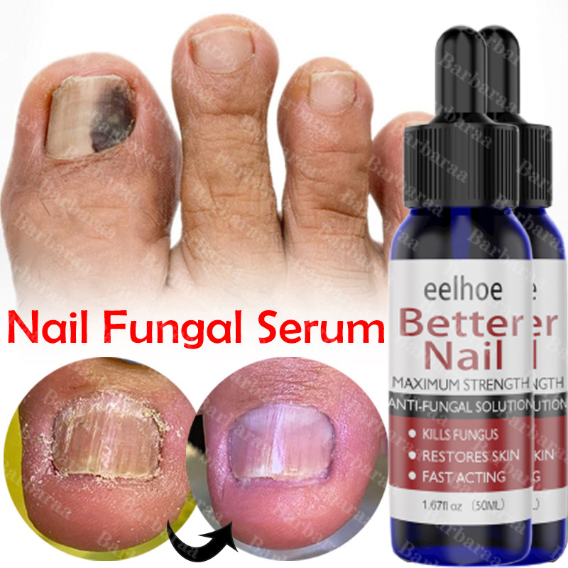 Nail Fungus Serum Anti-fungal Nail Serum Nail Fungus Removal Toe ...