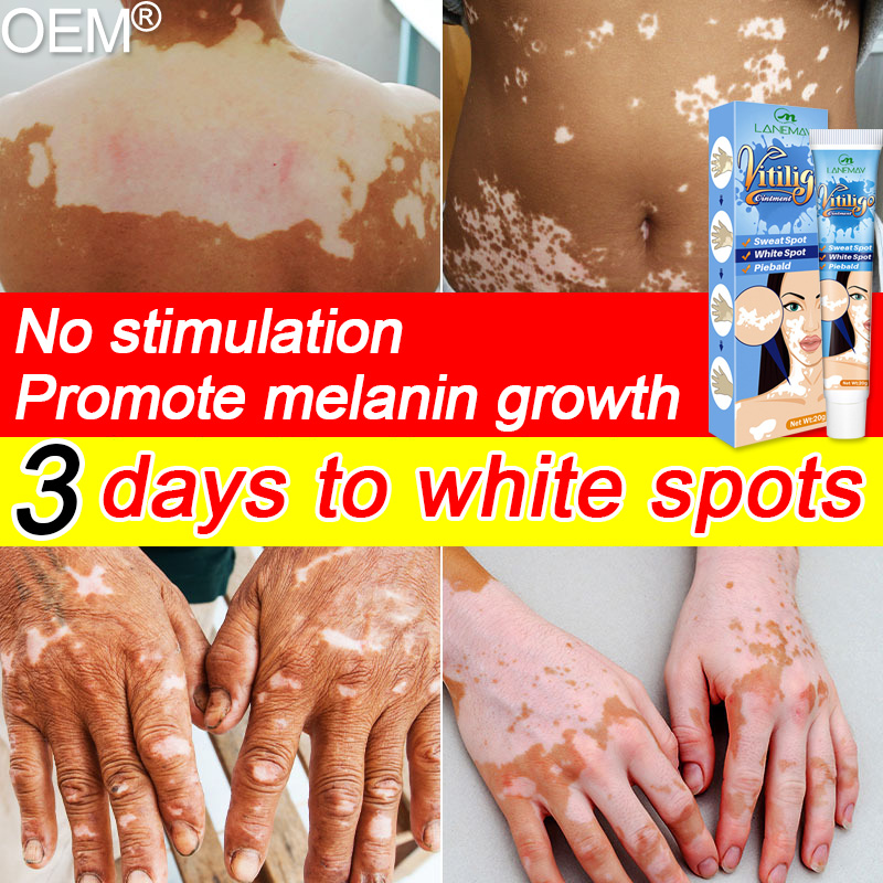 Effective in 3 days OEM atoderma cream vitiligo treatment cream Whole