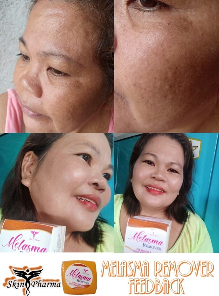 best moisturizer for melasma