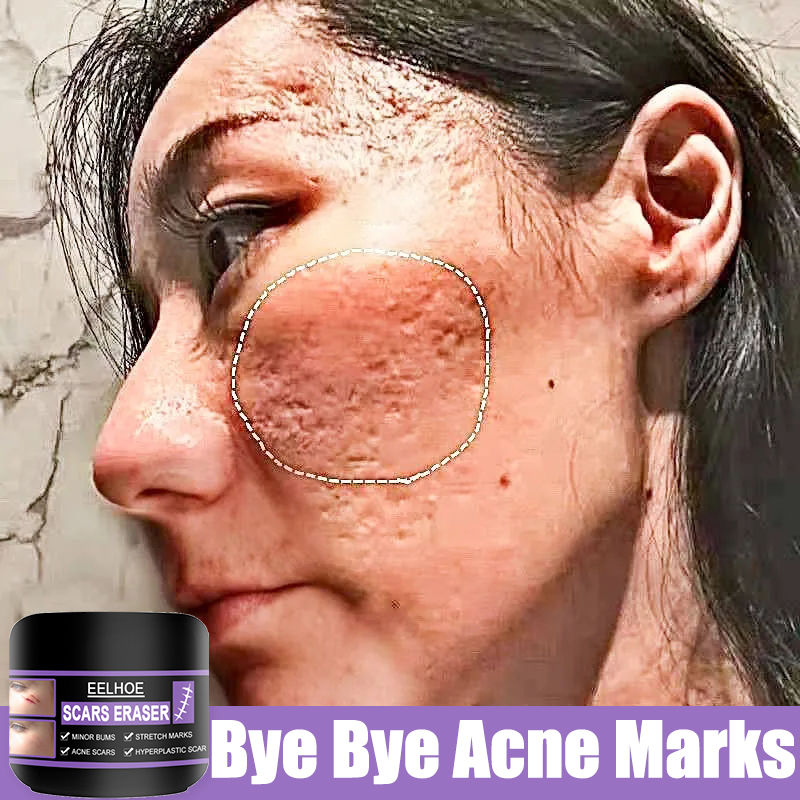 COD 💖 Scar Remover pimple marks remover acne scar remover scars remover