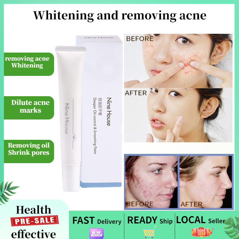 Anti Acne facial wash pimple remover Face whitening Acne closed mouth ...