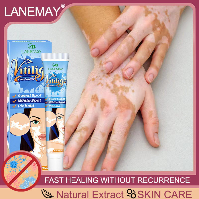 Effective within 1 days vitiligo treatment cream Quick freckle removal