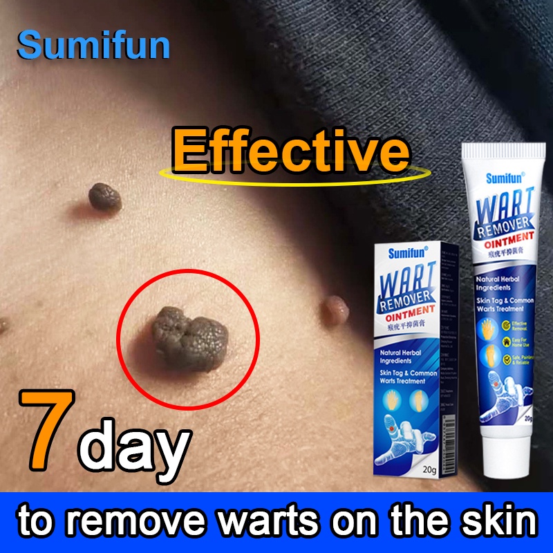 【sumifun】b1t1 Warts Remover Original Cream Warts Magic Remover Wartz Removal Cream Warts Remover