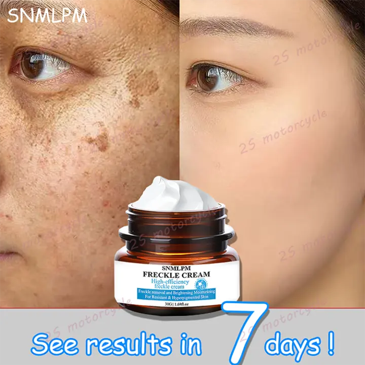 cream for freckles on face