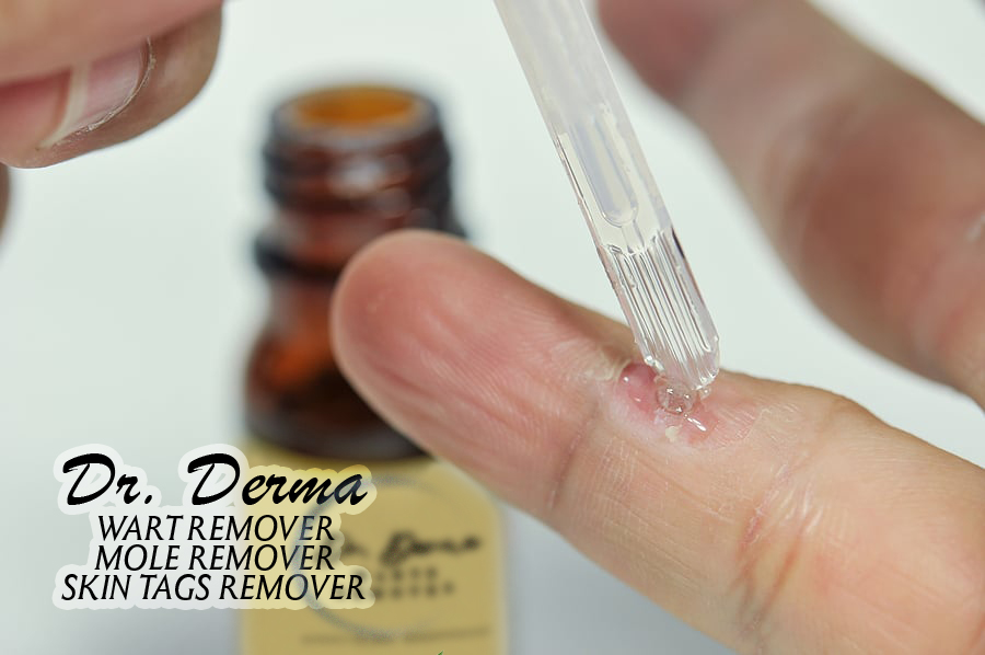 Remover pen for moles, skin tags