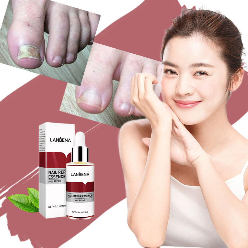 lanbena-nail-repair-essence-nail-fungus-treatment-remove-onychomycosis