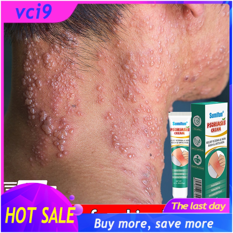 Hot 】Sumifun Psoriasis Cream 20g Antibacterial and quick relief of ...