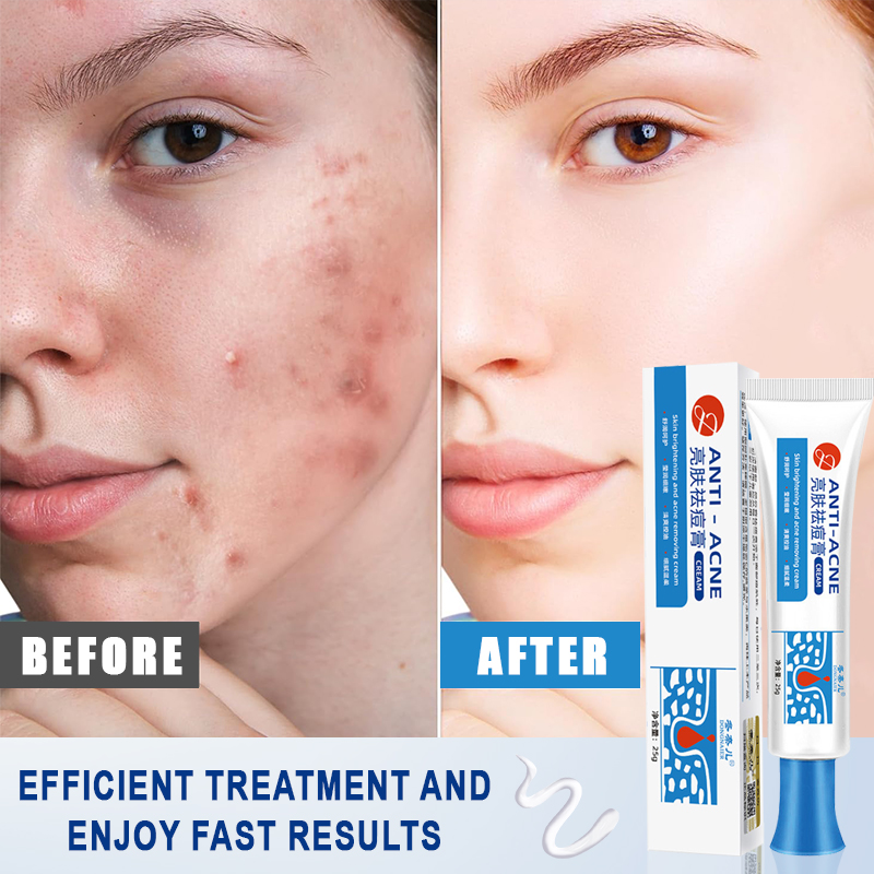 Acne Remover Cream Pimple Marks Remover Cream Acne Treatment Acne Scar Remover Anti Acne Gel 25g 1082