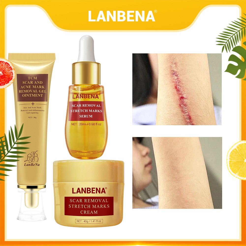 lanbena stretch mark removal