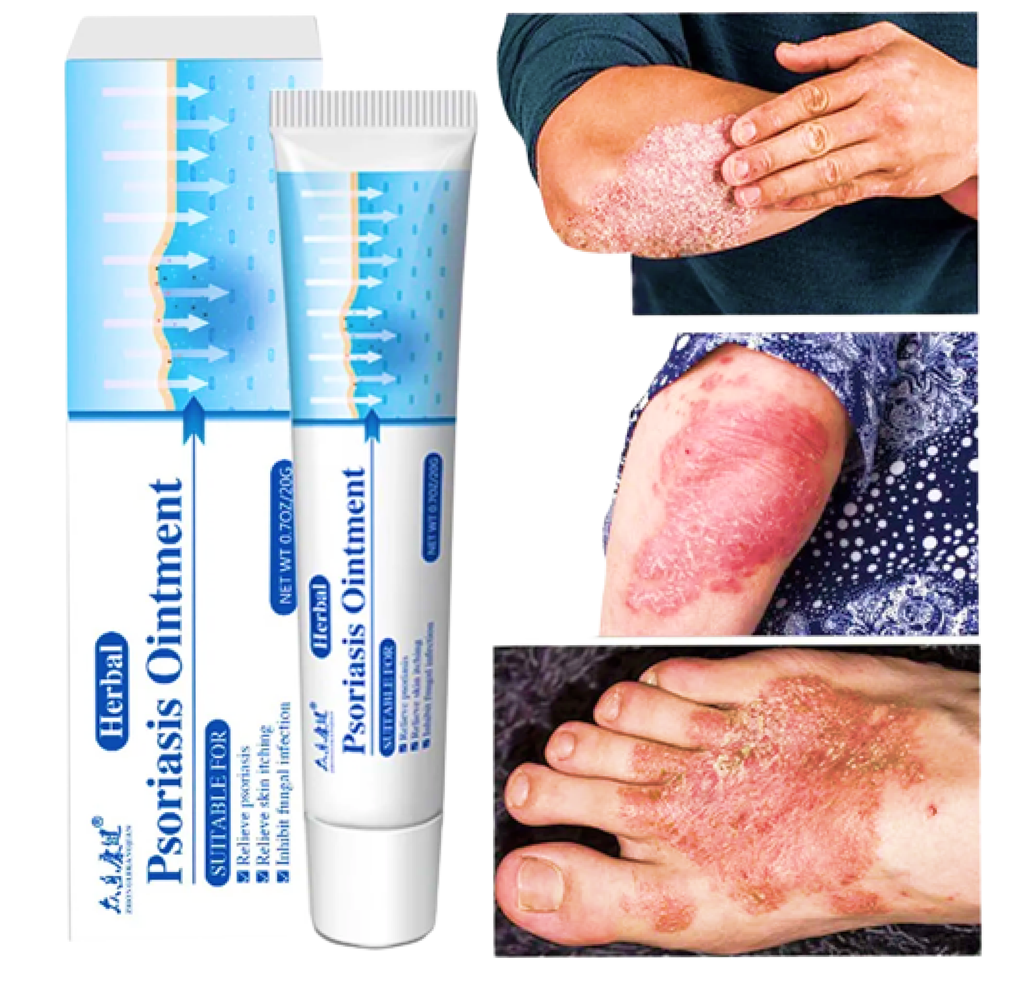 100% Original Psoriasis Cream Psoriasis Eczema Pruritus Itchiness ...