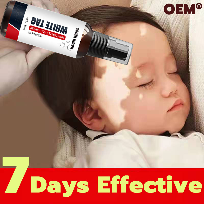 【100 effective】South Moon® tinea versicolor treatment vitiligo