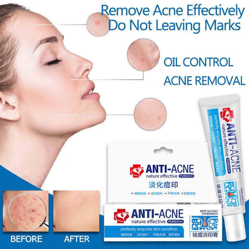 remove-pimples-quickly-pimple-remover-acne-cream-fades-acne-marks