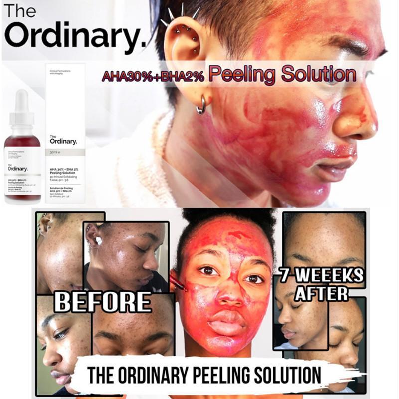 the ordinary aha acne