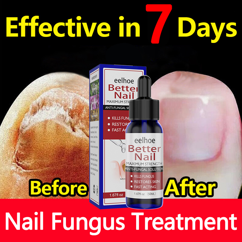 【100 Effective in 5 days】Eelhoe Nail repair treatment cream Nail