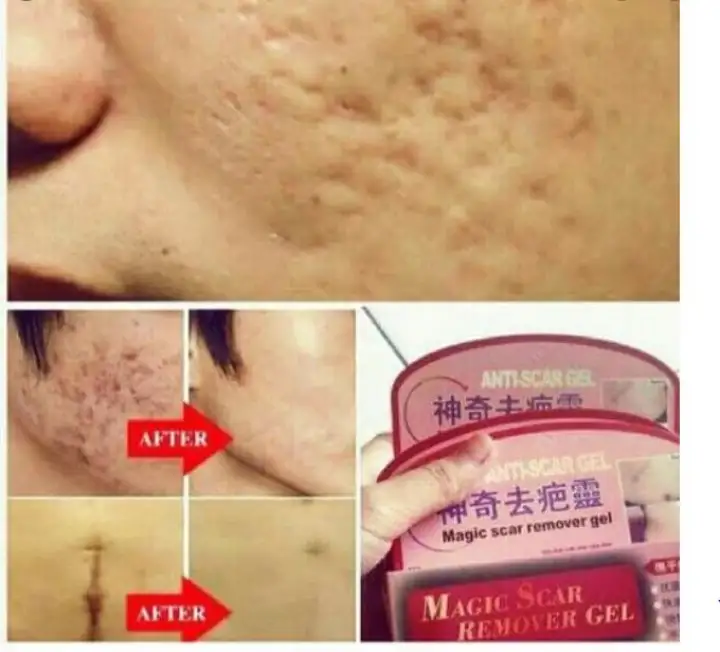 best pimple scar remover