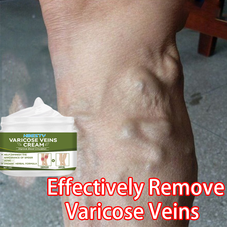 HBESTY Varicose Vein Treatment Cream 50g Spider Vein Pain Varicosity ...