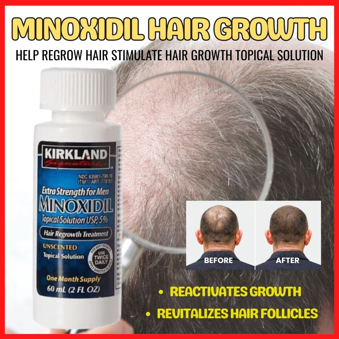 Trendz Minoxidil Hair Growth Treatment Minoxidil Revitalizes Hair