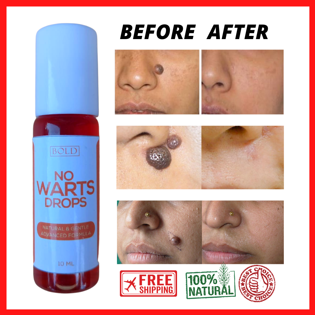 [INES STORE] NO WARTS DROPS Best for Healing Warts and Well-Proven Cure ...